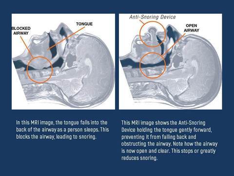 Apnea Tongue Stabilizing Device - Image 4